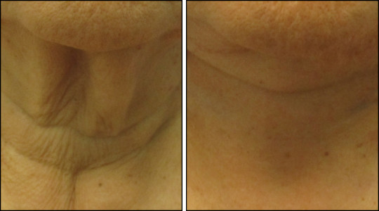 facelift